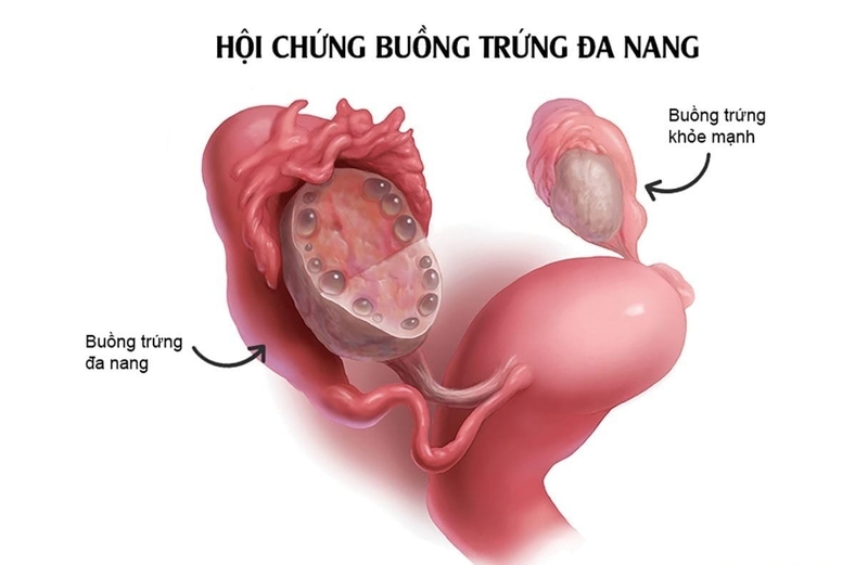 Đa nang buồng trứng là cách gọi phổ biến của hội chứng buồng trứng đa nang