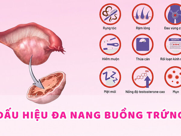 Các dấu hiệu như kinh nguyệt không đều, mụn nội tiết, rậm lông và rụng tóc có thể liên quan đến PCOS. 
