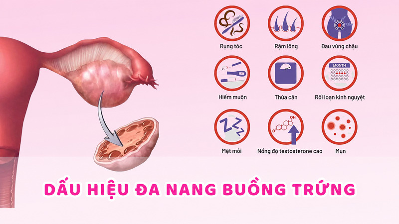 Các dấu hiệu như kinh nguyệt không đều, mụn nội tiết, rậm lông và rụng tóc có thể liên quan đến PCOS. 